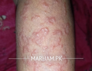 Skin Issue (Allergy)