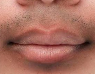 Upper Lips Per Dark Hair