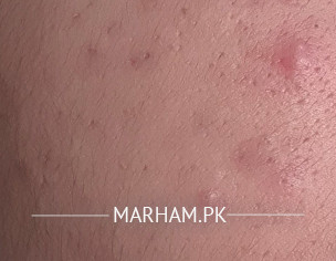 Pimples Problem Since 3 Years