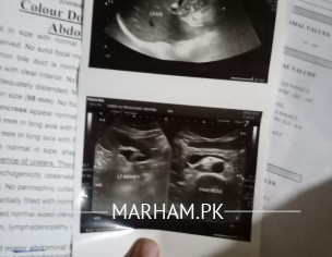 Dirhea About 20 Days