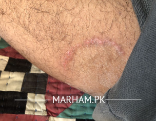 Round Embossed Patch On Thigh Inner