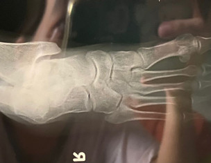Foot Fracture