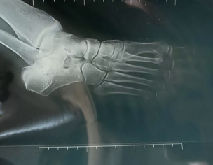 Foot Fracture