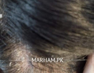 Dandruff Plus Redness