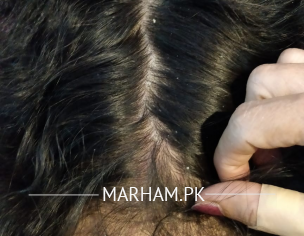 Dandruff Plus Redness