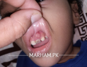 Teething Issue