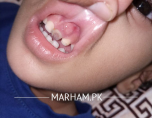 Teething Issue