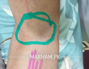 Leg Pain While Walking.