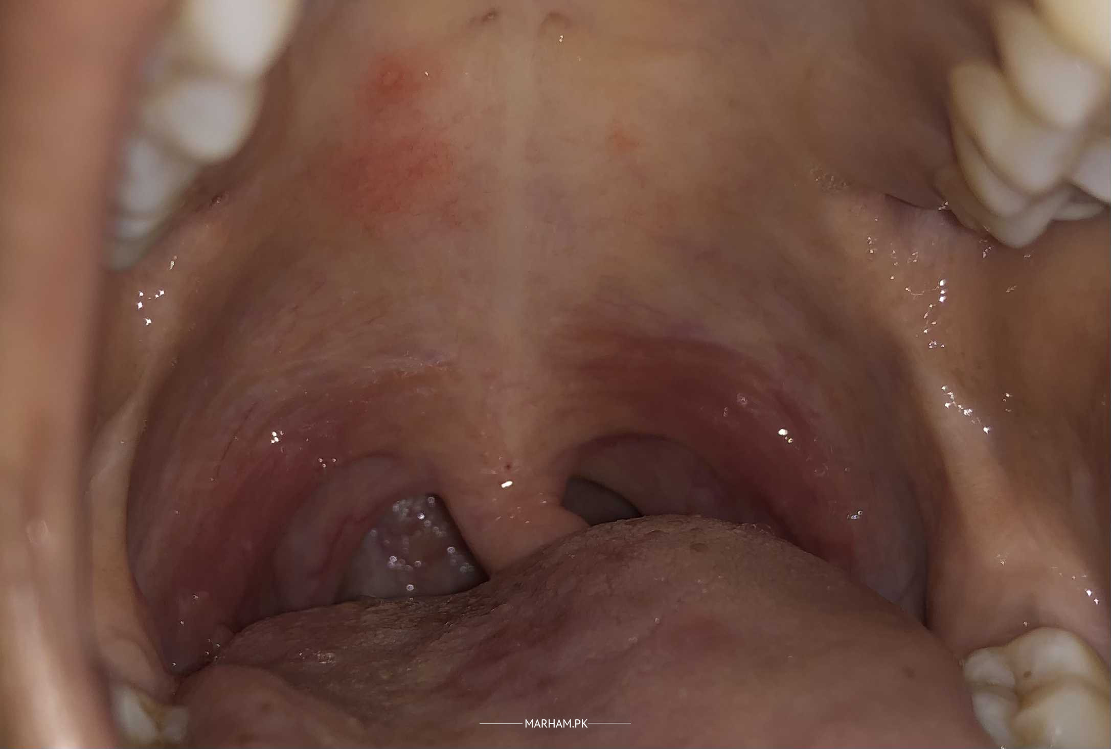 Close-up internal view of mouth and throat showing redness, white patches and inflammation consistent with oral thrush or infection