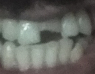 Broken Tooth