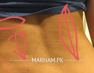 Flank P, Urinary Inflammation