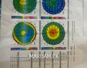 Keratoconus 