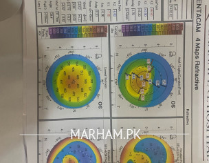 Keratoconus 