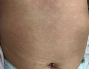 Skin Spots