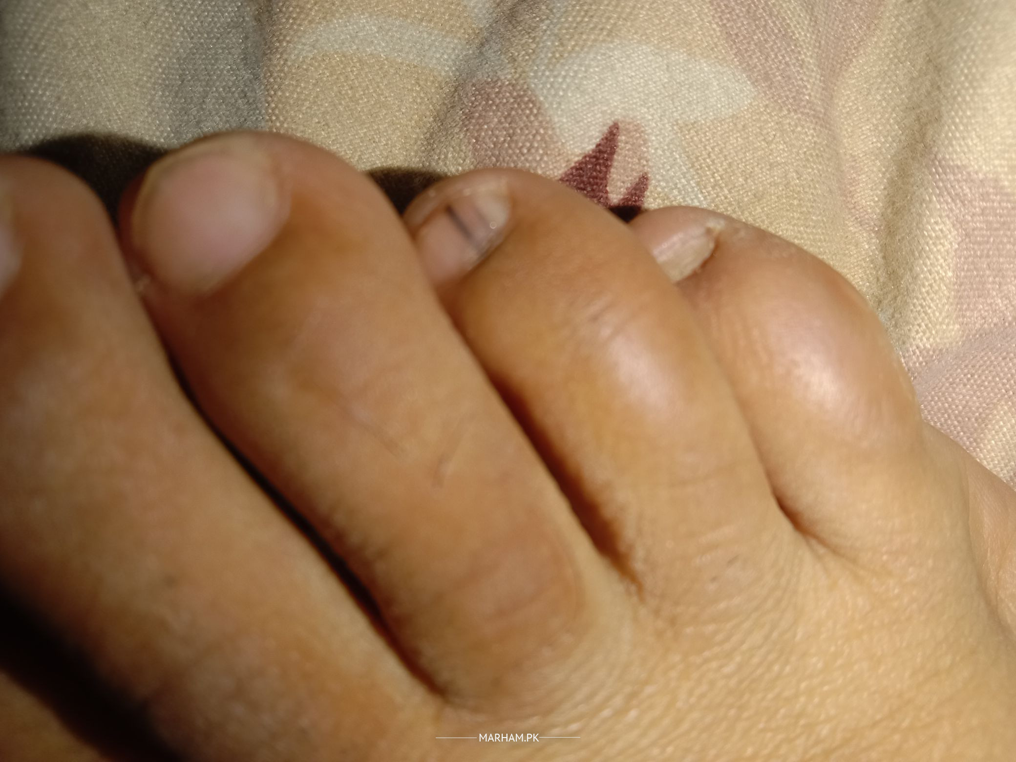 Finger nail streak: Symptom of skin cancer Subungual melanoma | news.com.au  — Australia's leading news site