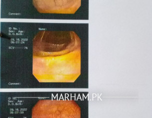 Stool Evacuation Problem