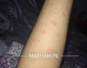 Skin Allergy (Rashes)