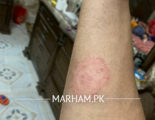 Marks On Body Like Ring Worms