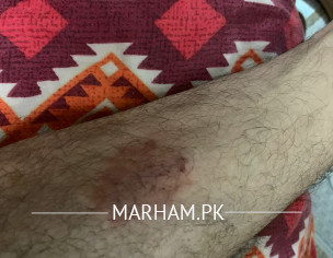 Marks On Body Like Ring Worms