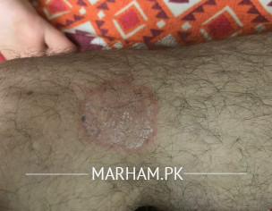 Marks On Body Like Ring Worms