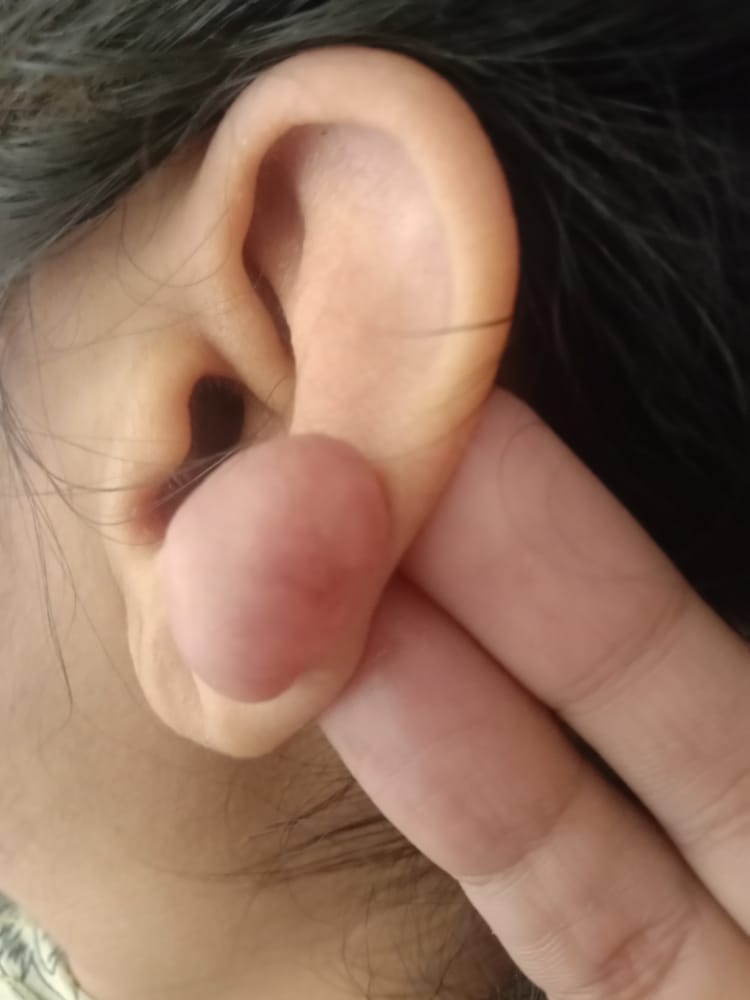 infected ear piercing bump