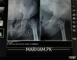 Hip Joint, Leg Pain.