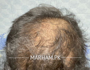 Hair Fall Issue From Past 7 8 Years