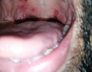 Some Spots In Upper Palate