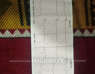 Ecg. Heart Beat Missing