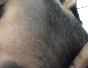 Hyperpigmentation/melasma, Discoloration On Face