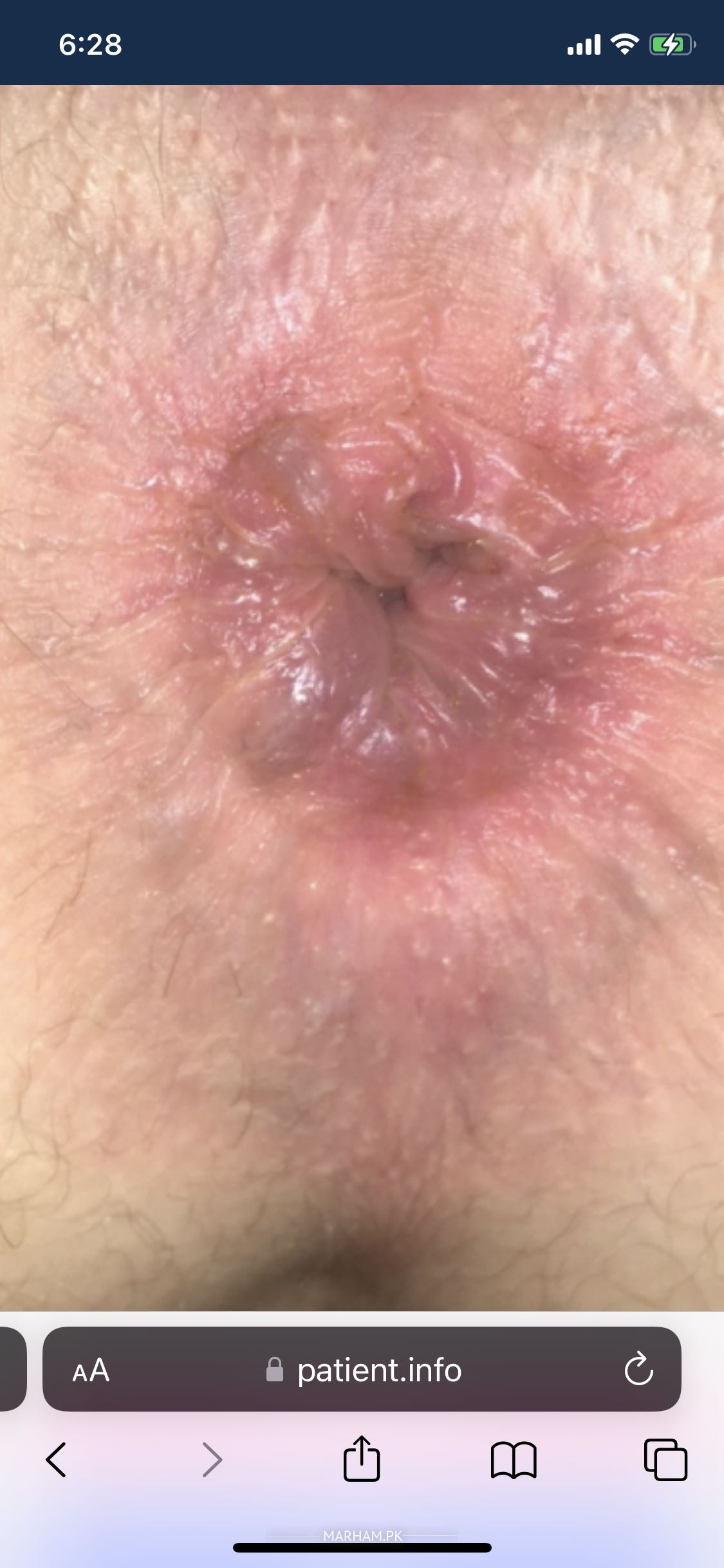 Ask a Gastroenterologist Online for Swollen Anus