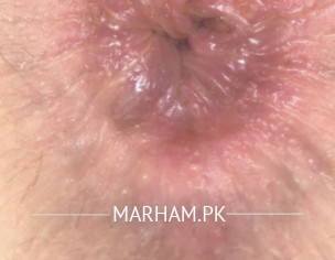 Swollen Anus