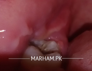 Molar Teeth Infection