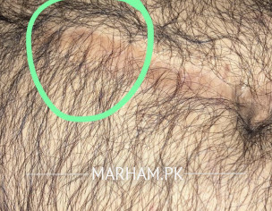 Portion On A Stitches Mark Is Swelled