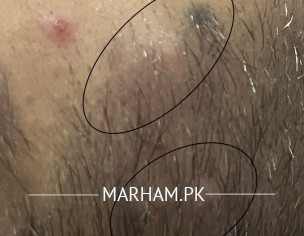 Headless Pimple On Cheek