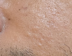 Small Swelling Areas On Skin