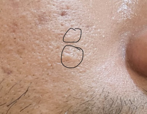 Small Swelling Areas On Skin