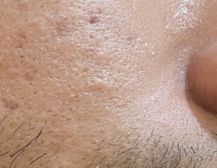 Small Swelling Areas On Skin