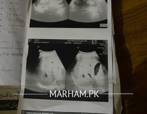 UTI And Poor Sperm Motility