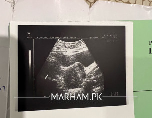 Fibroid After Cesarian