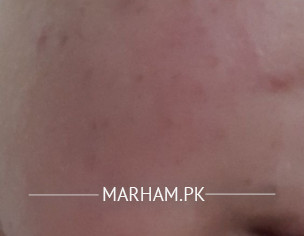 Redness And Patch On Cheeks