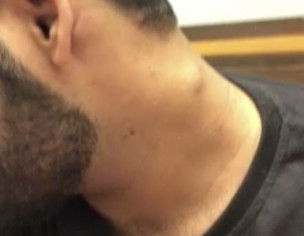 Lump In Neck