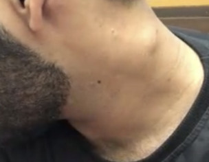 Lump In Neck