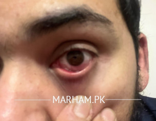 Pimple Inside Eye