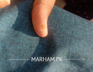 Wart