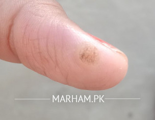 Wart