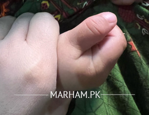 Baby Thumb Dislocated 