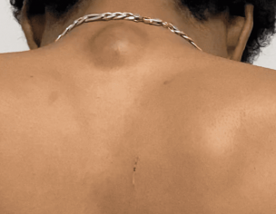 Large Lump Behind Neck