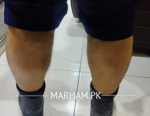 DVT, Spasm, Or Normal Calf