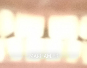 Gap In Upper Front Teeth